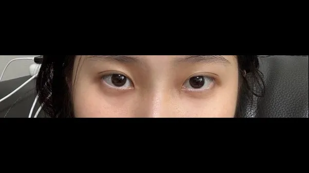 Natural Adhesion Double Eyelid Surgery, Ptosis Correction — RE&RE PLASTIC SURGERY 3