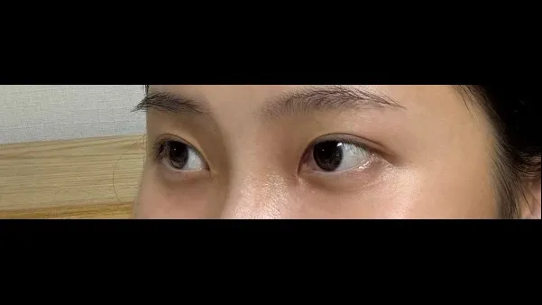 Natural Adhesion Double Eyelid Surgery, Ptosis Correction — RE&RE PLASTIC SURGERY 5