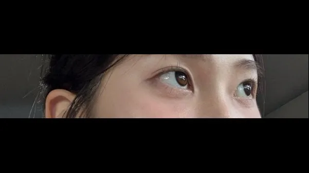Natural Adhesion Double Eyelid Surgery, Ptosis Correction — RE&RE PLASTIC SURGERY 6