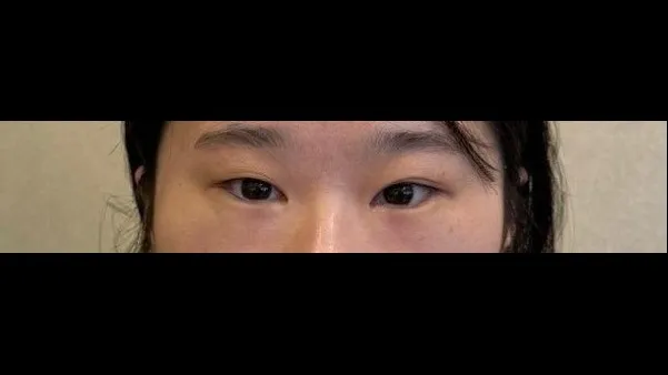 Incisional Double Eyelid Surgery, Ptosis Correction 1
