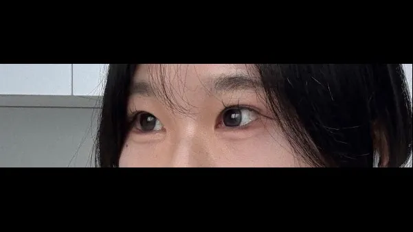 Incisional Double Eyelid Surgery, Ptosis Correction — RE&RE PLASTIC SURGERY 2