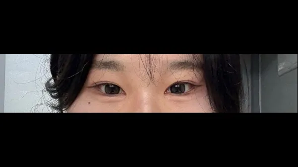 Incisional Double Eyelid Surgery, Ptosis Correction — RE&RE PLASTIC SURGERY 3