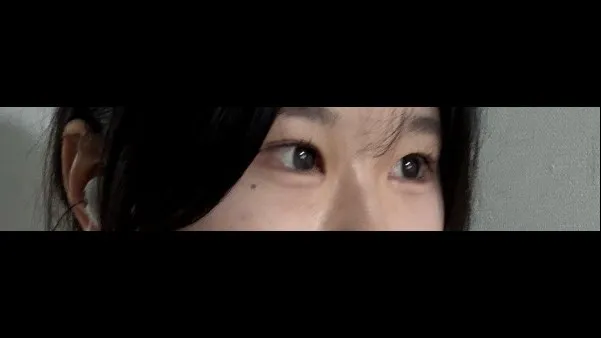 Incisional Double Eyelid Surgery, Ptosis Correction — RE&RE PLASTIC SURGERY 4