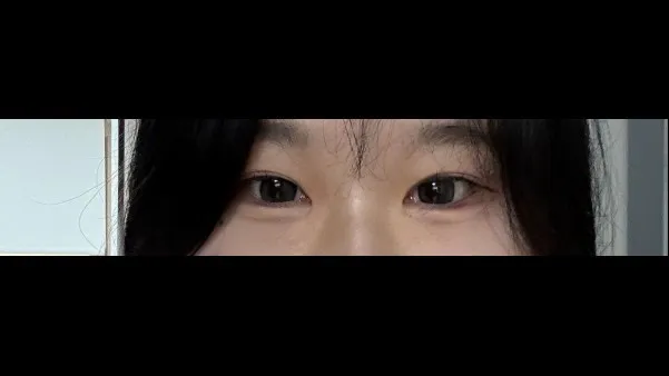 Incisional Double Eyelid Surgery, Ptosis Correction — RE&RE PLASTIC SURGERY 5
