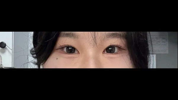 Incisional Double Eyelid Surgery, Ptosis Correction — RE&RE PLASTIC SURGERY 6