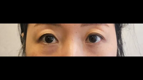 Partial Incision Double Eyelid Surgery 1