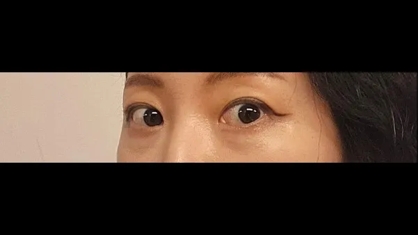 Partial Incision Double Eyelid Surgery — RE&RE PLASTIC SURGERY 2