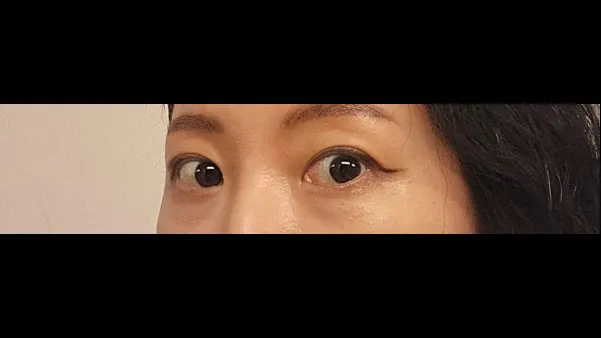 Partial Incision Double Eyelid Surgery — RE&RE PLASTIC SURGERY 3
