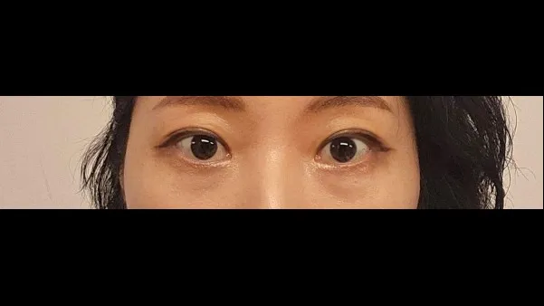 Partial Incision Double Eyelid Surgery — RE&RE PLASTIC SURGERY 4