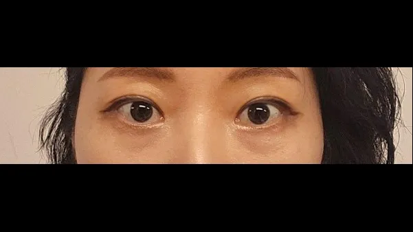 Partial Incision Double Eyelid Surgery — RE&RE PLASTIC SURGERY 5