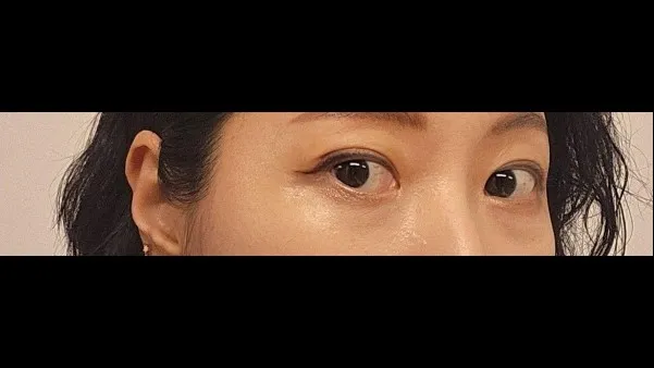 Partial Incision Double Eyelid Surgery — RE&RE PLASTIC SURGERY 6