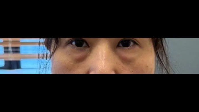 Lower Blepharoplasty (Aging Eye Rejuvenation), Midface Lift 1