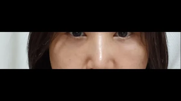 Lower Blepharoplasty (Aging Eye Rejuvenation), Midface Lift — RE&RE PLASTIC SURGERY 2