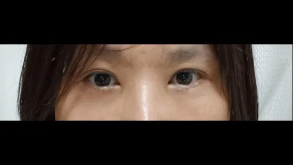Lower Blepharoplasty (Aging Eye Rejuvenation), Midface Lift — RE&RE PLASTIC SURGERY 4