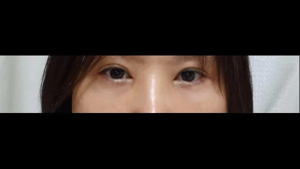 Lower Blepharoplasty (Aging Eye Rejuvenation), Midface Lift — RE&RE PLASTIC SURGERY 5