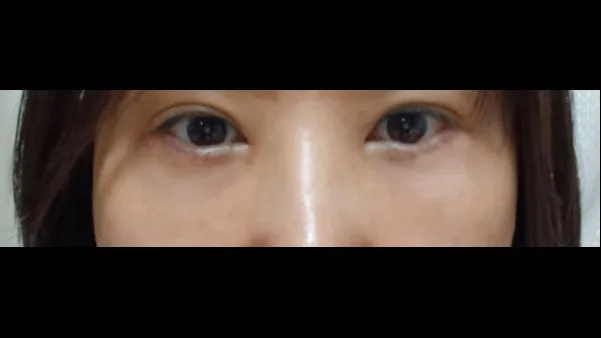 Lower Blepharoplasty (Aging Eye Rejuvenation), Midface Lift — RE&RE PLASTIC SURGERY 6
