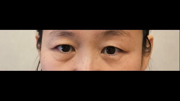 Natural Adhesion Double Eyelid Surgery 1