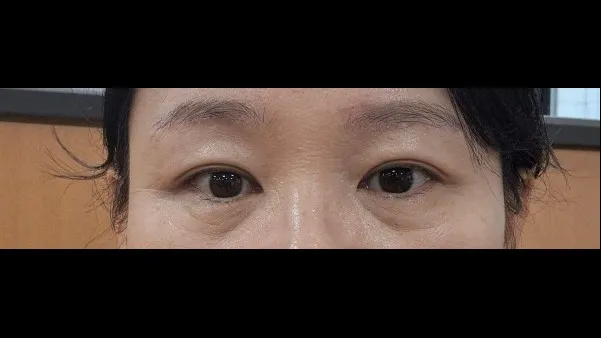 Natural Adhesion Double Eyelid Surgery 2