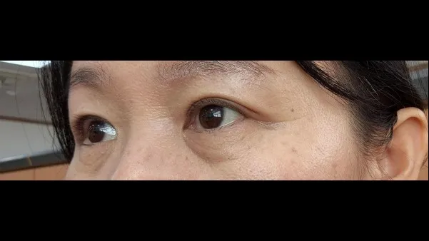 自然癒着法 — RE&RE PLASTIC SURGERY 3
