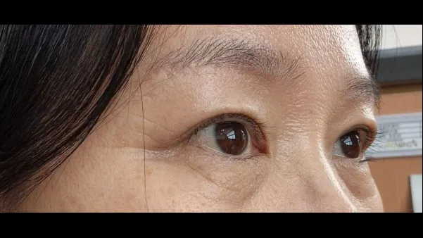 自然癒着法 — RE&RE PLASTIC SURGERY 4