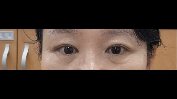 自然癒着法 — RE&RE PLASTIC SURGERY 5