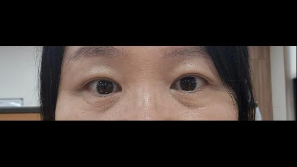 自然癒着法 — RE&RE PLASTIC SURGERY 6