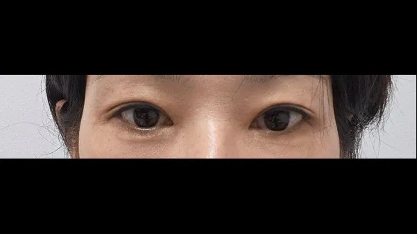 Incisional Double Eyelid Surgery — RE&RE PLASTIC SURGERY 2