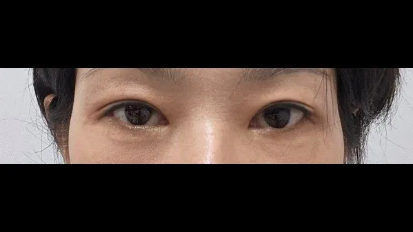 Incisional Double Eyelid Surgery — RE&RE PLASTIC SURGERY 3