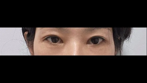 Incisional Double Eyelid Surgery — RE&RE PLASTIC SURGERY 4