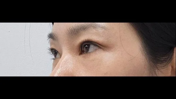 Incisional Double Eyelid Surgery — RE&RE PLASTIC SURGERY 5