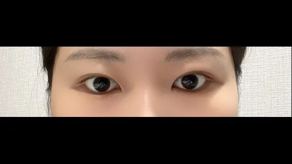 Natural Adhesion Double Eyelid Surgery, Ptosis Correction — RE&RE PLASTIC SURGERY 2