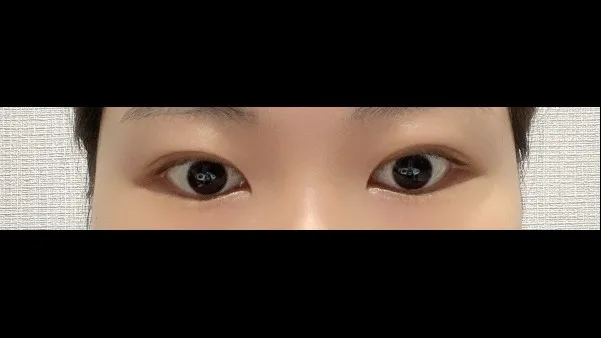 Natural Adhesion Double Eyelid Surgery, Ptosis Correction — RE&RE PLASTIC SURGERY 3
