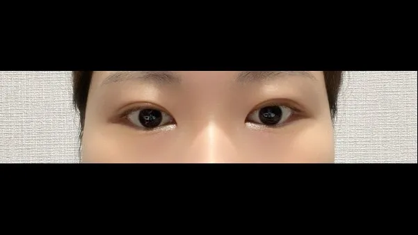 Natural Adhesion Double Eyelid Surgery, Ptosis Correction — RE&RE PLASTIC SURGERY 4