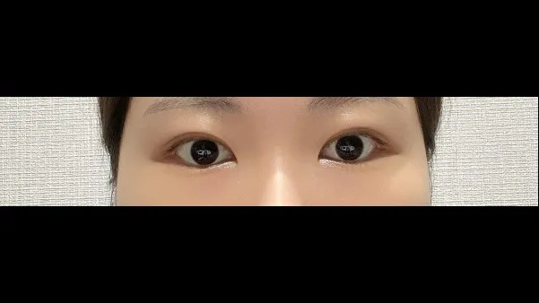 Natural Adhesion Double Eyelid Surgery, Ptosis Correction — RE&RE PLASTIC SURGERY 5
