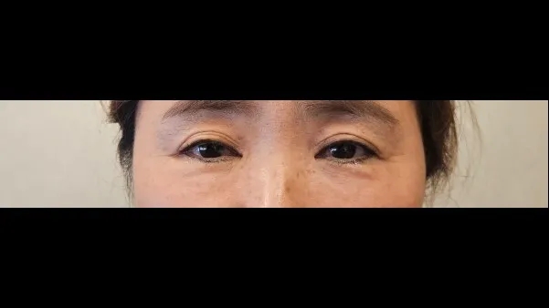 Sub-brow Lift, Ptosis Correction 1