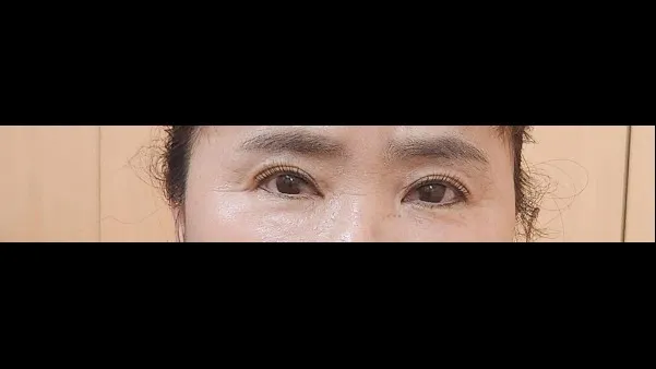 眉下リフト, 目つき矯正 — RE&RE PLASTIC SURGERY 2