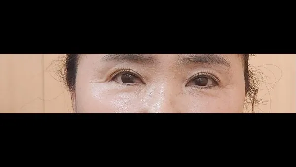 眉下リフト, 目つき矯正 — RE&RE PLASTIC SURGERY 3