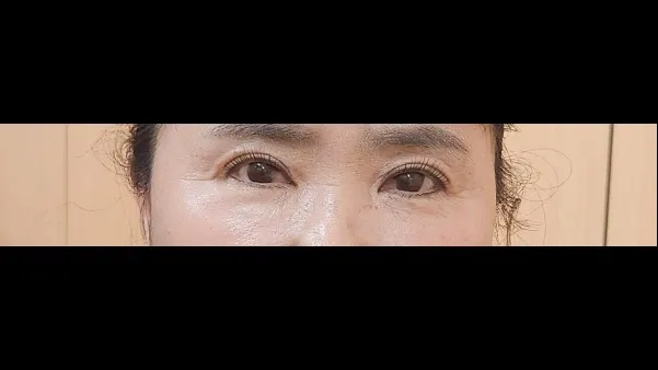眉下リフト, 目つき矯正 — RE&RE PLASTIC SURGERY 4