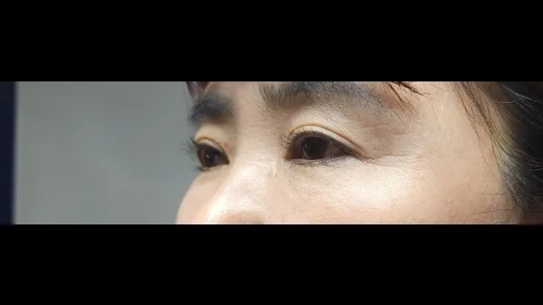 眉下リフト, 目つき矯正 — RE&RE PLASTIC SURGERY 5