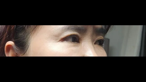 眉下リフト, 目つき矯正 — RE&RE PLASTIC SURGERY 6