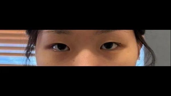 Natural Adhesion Double Eyelid Surgery, Ptosis Correction 1