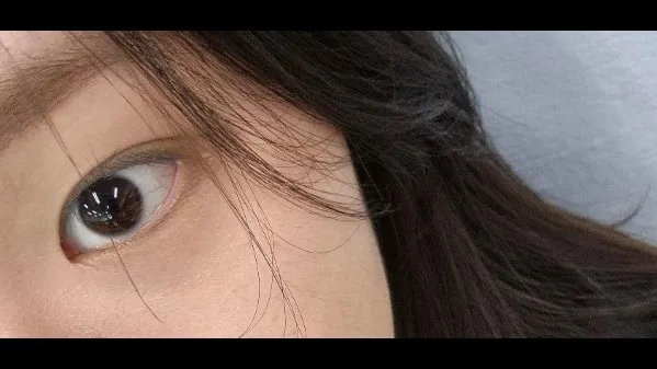 Natural Adhesion Double Eyelid Surgery, Ptosis Correction 2