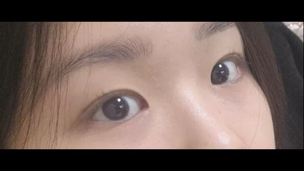 自然癒着法, 目つき矯正 — RE&RE PLASTIC SURGERY 3