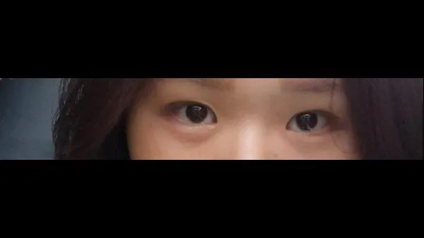 自然癒着法, 目つき矯正 — RE&RE PLASTIC SURGERY 4