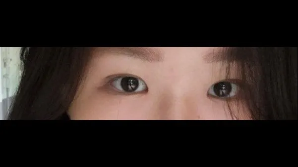 自然癒着法, 目つき矯正 — RE&RE PLASTIC SURGERY 5