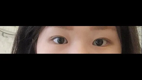 自然癒着法, 目つき矯正 — RE&RE PLASTIC SURGERY 6