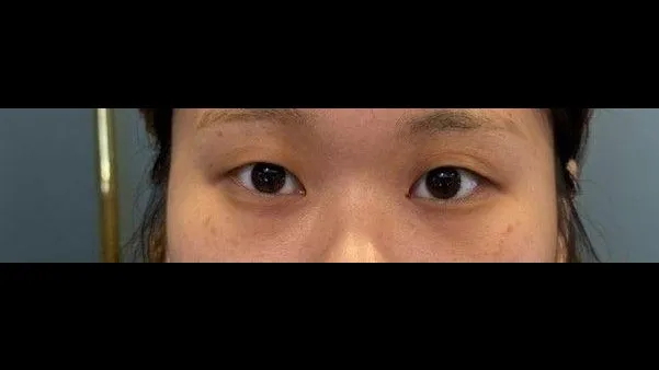 Natural Adhesion Double Eyelid Surgery, Ptosis Correction 1