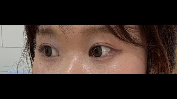 Natural Adhesion Double Eyelid Surgery, Ptosis Correction 2