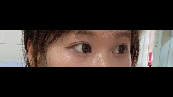 自然癒着法, 目つき矯正 — RE&RE PLASTIC SURGERY 3