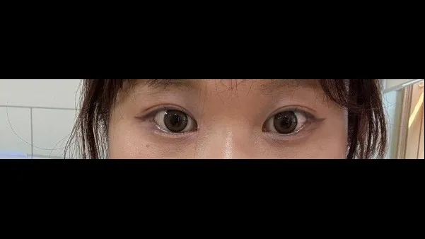 自然癒着法, 目つき矯正 — RE&RE PLASTIC SURGERY 4
